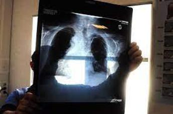 Tumori, lo screening del cancro al polmone funziona e allunga la vita